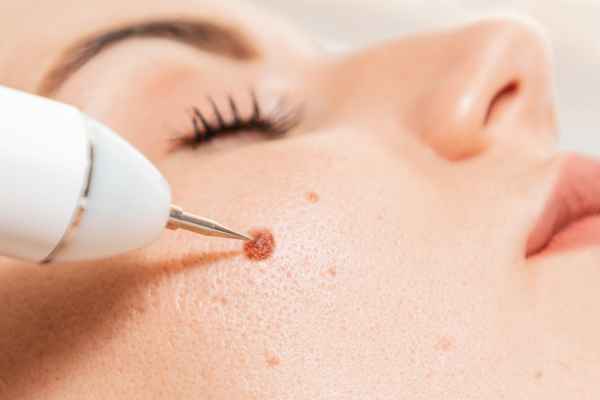 CryoPen: 5 Skin Concerns It May Be Used to Treat 3 What actually happens during a CryoPen treatment Hythe?