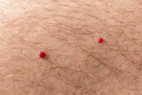 CryoPen: 5 Skin Concerns It May Be Used to Treat 2 cherry angioma removal Hythe