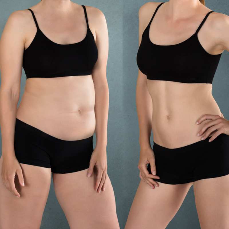 Does Fat Freezing at Home Work? DIY Devices vs Professional Cryolipolysis 2 before and after Cryolipolysis Hythe