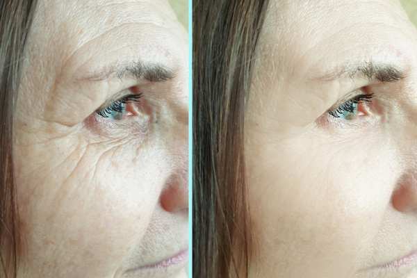 Why Do People Choose HIFU for a Non-Surgical Facelift? 4 How long can HIFU results last Hythe?