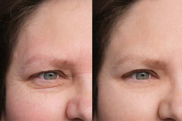 HIFU vs Botulinum Toxin: Understanding the Differences 4 How long do HIFU results last Hythe?