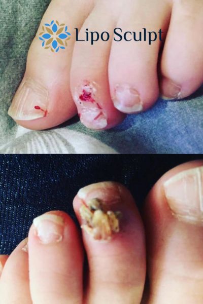 Wart removal customer results from Lipo Sculpt Hythe
