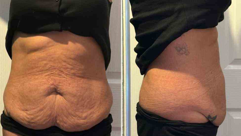 Lost the Weight but Not the Loose Skin? What You Should Know 1 Is It Definitely Loose Skin Hythe?